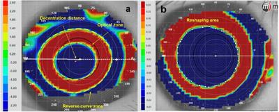 Analysis of corneal surface shape following overnight orthokeratology with different optical zone diameters